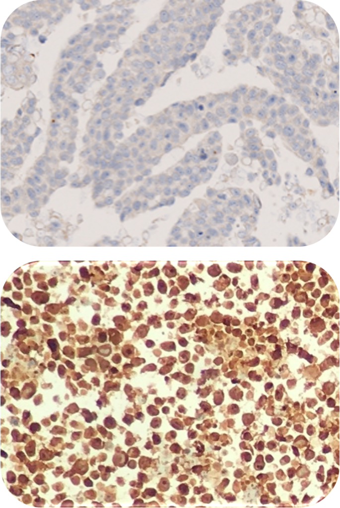 ALKLymphoma Analyte Control HistoCyte