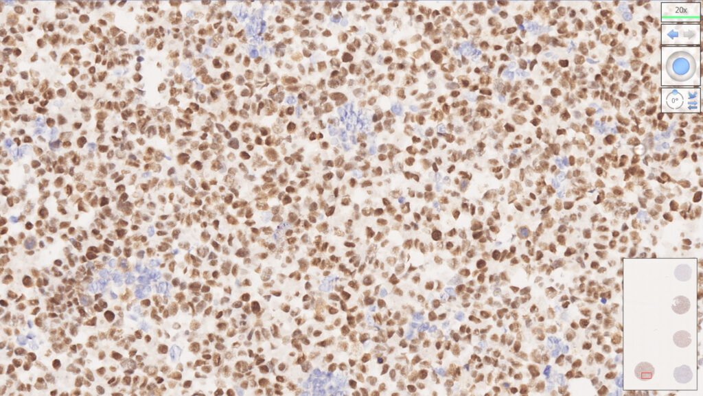 MLH1/PMS2 Analyte Control - HistoCyte